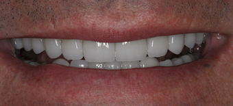 Full mouth dental reconstruction after 90862