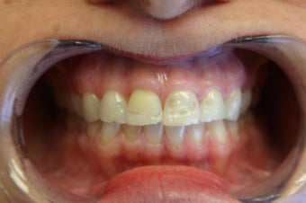 6 veneer before 360131