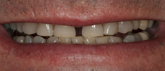 Full mouth dental reconstruction before 90862