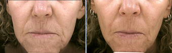 Pro-Fractional Laser before 333847