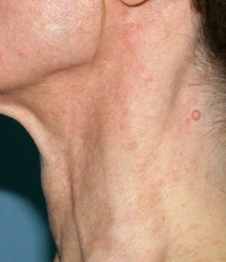 PDL treatment on neck after 374533