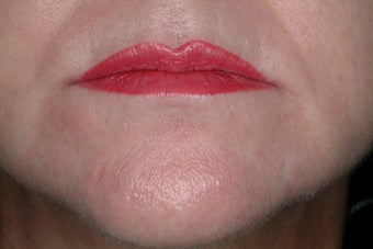 Radiesse and Botox after 86807