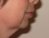 Injectables before 112085