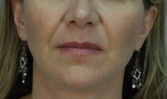Radiesse injection to ML folds (Laugh lines) before 167713