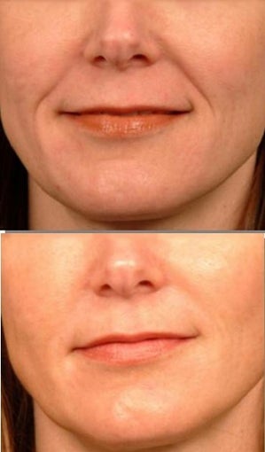 Radiesse to smile lines before 6517