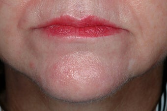 Radiesse and Botox before 86807