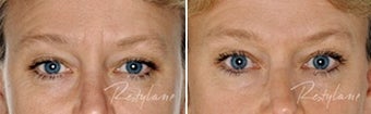 Before and after Restylane on fine lines before 6271
