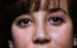Rhinoplasty revision after 130783