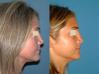 Revision Rhinoplasty before 117311