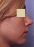 Rhinoplasty revision before 130776