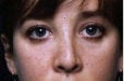 Rhinoplasty revision before 130783