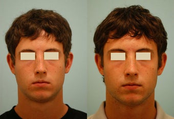 Revision/Corrective Rhinoplasty before 136568