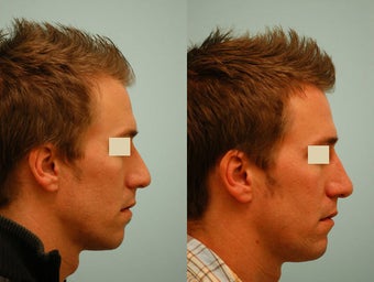 Revision/Corrective Rhinoplasty before 136570
