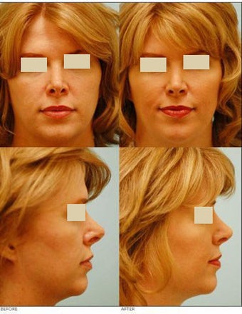 Revision/Corrective Rhinoplasty before 136572