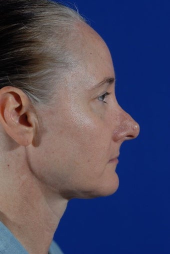 Revision Rhinoplasty before 274927