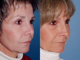 Revision rhinoplasty after 334293