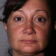 Revision Rhinoplasty after 443003