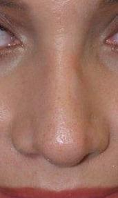 Revision Rhinoplasty after 463582