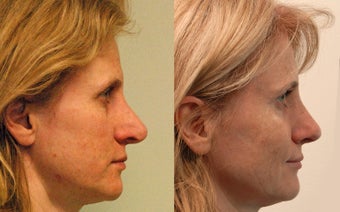 Open revision Rhinoplasty with auricular grafting after 471368