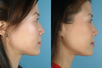 Revision Rhinoplasty before 302687