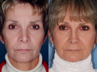 Revision rhinoplasty before 334293