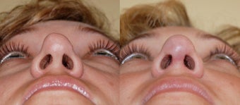 Revision rhinoplasty before 359003