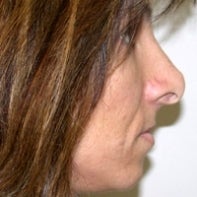 Revision Rhinoplasty before 442996