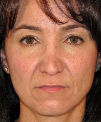 Revision Rhinoplasty before 454238