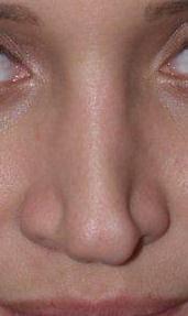 Revision Rhinoplasty before 463582