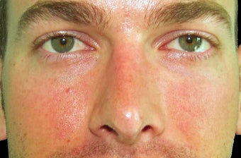 Rhinoplasty