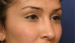 Rhinoplasty after 130763