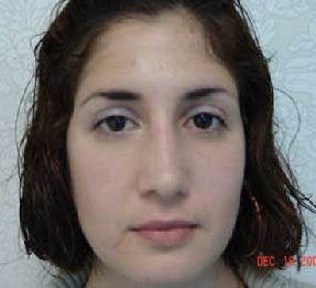 Rhinoplasty after 172963