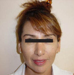 Rhinoplasty after 172983