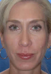 Rhinoplasty after 319085