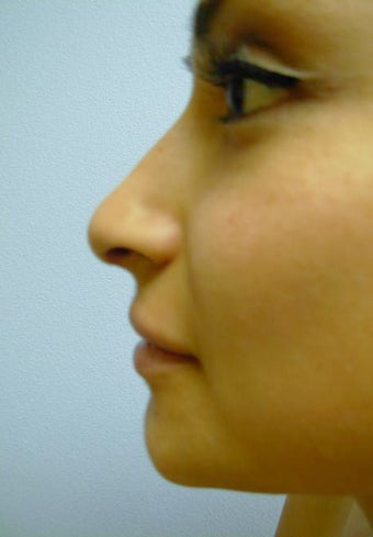 Rhinoplasty after 355874