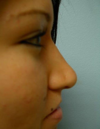 Rhinoplasty after 355875