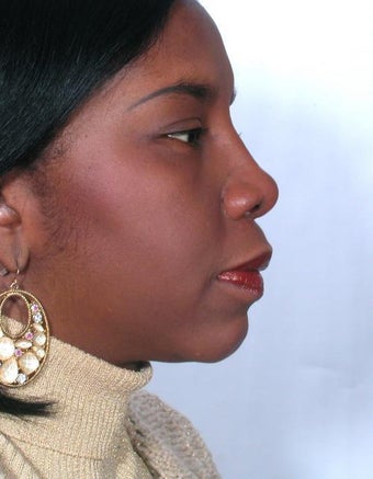 Rhinoplasty after 358918