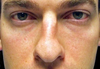 Rhinoplasty