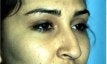 Rhinoplasty before 130763