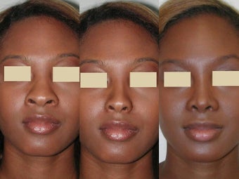 African American Rhinoplasty before 137732