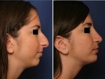 Rhinoplasty and chin implant before 143599