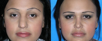 Rhinoplasty before 163637