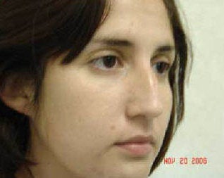 Rhinoplasty before 172963
