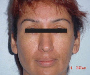 Rhinoplasty before 172983