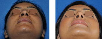 Rhinoplasty before 271491