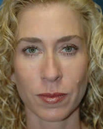 Rhinoplasty before 319085