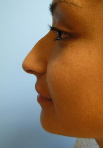 Rhinoplasty before 355874