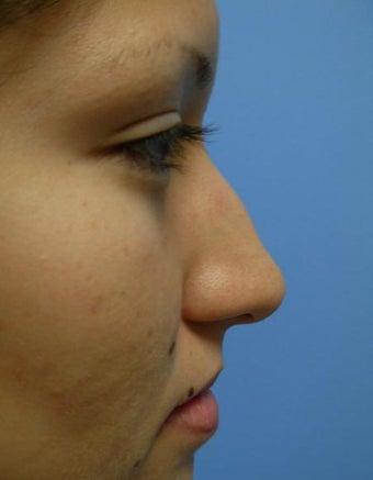 Rhinoplasty before 355875