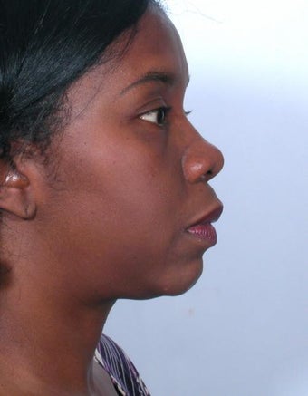 Rhinoplasty before 358918