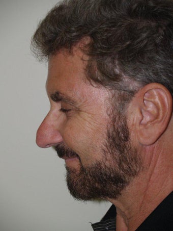 Rhinoplasty before 495965